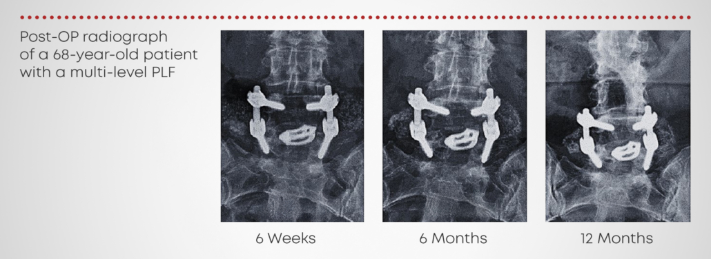 68-year-old patient with multi-level PLF showing progressive fusion at 3, 6, and 12 months